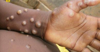 جدري القرد: 48 حالة مؤكدة في اليونان