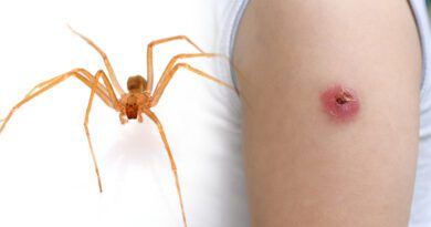 وفاة رجل في بيرغوس بعد تعرضه للدغة عنكبوت الناسك البني السام